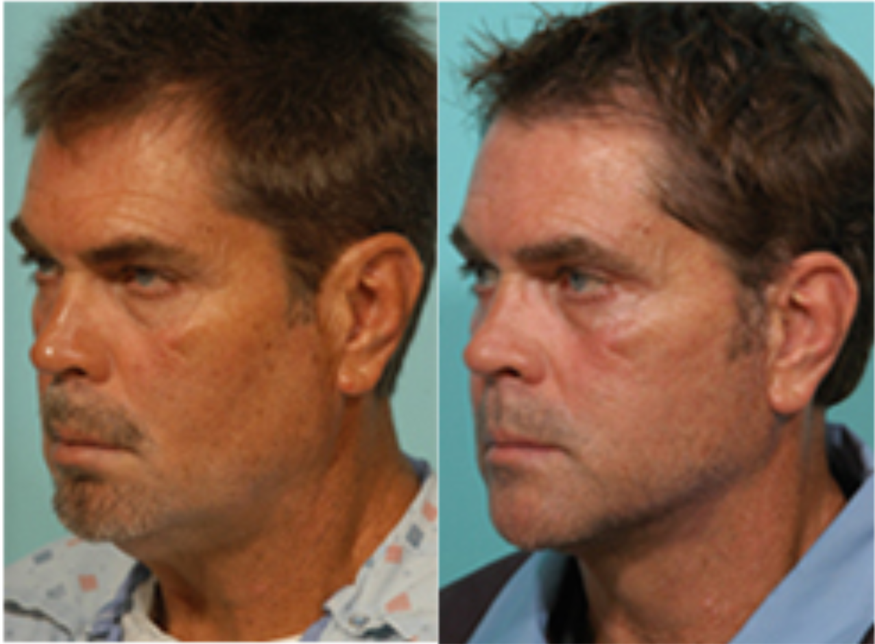 Endoscopic_Forehead_Lift Beeson Cosmetic Surgery